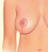 Breast Lift Surgery Johnson City